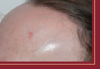 alopecia frontal fibrosante quito