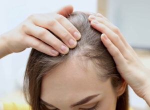 cirugia capilar Alopecia-femenina-