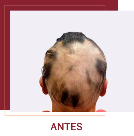 casos alopecia quito
