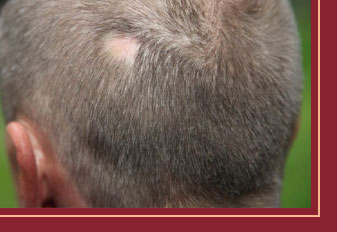alopecia quito por desordenes
