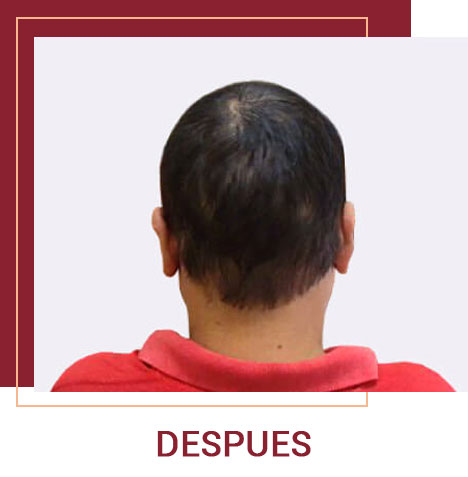 casos alopecia quito