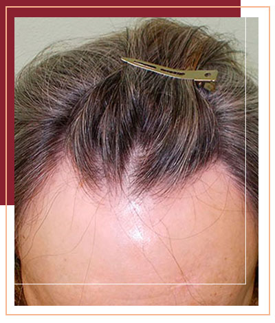 alopecia frontal fibrosante quito
